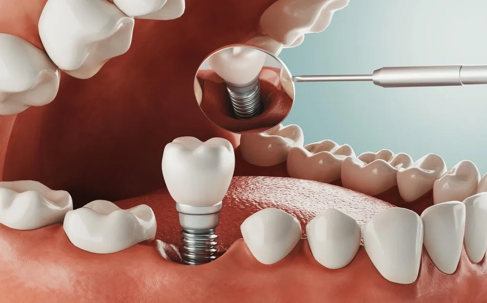 Same-Day Implants: Who Is Suitable for Immediate Tooth Replacement?