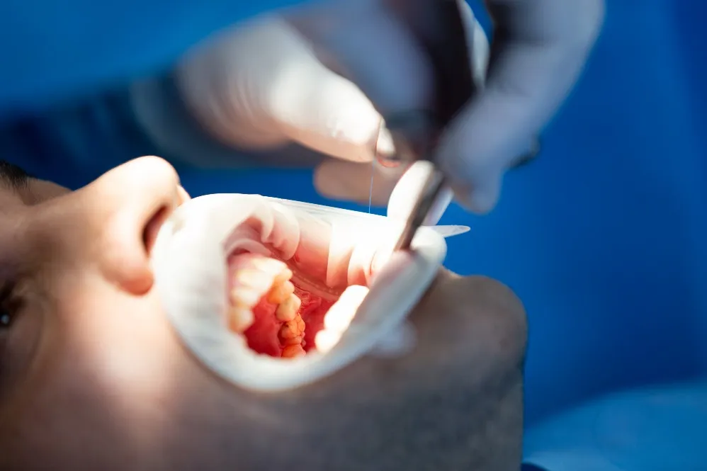 Oral Cyst Surgery: Symptoms, Diagnosis, and Treatment You Should Know