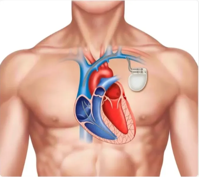 Permanent Pacemaker in Kalyan: Signs You May Need Long-Term Heart Rhythm Management