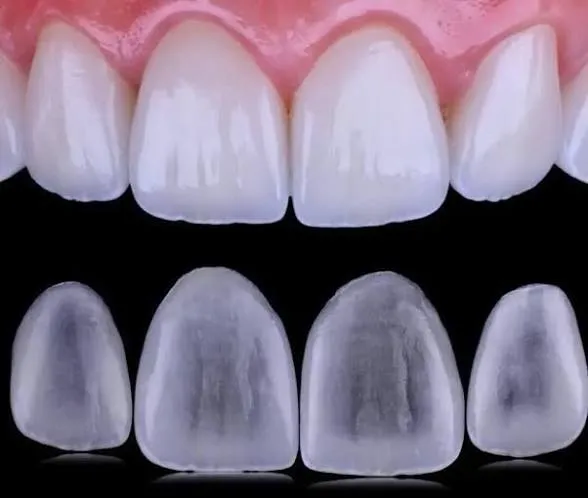 Why does food keep getting stuck between my teeth?