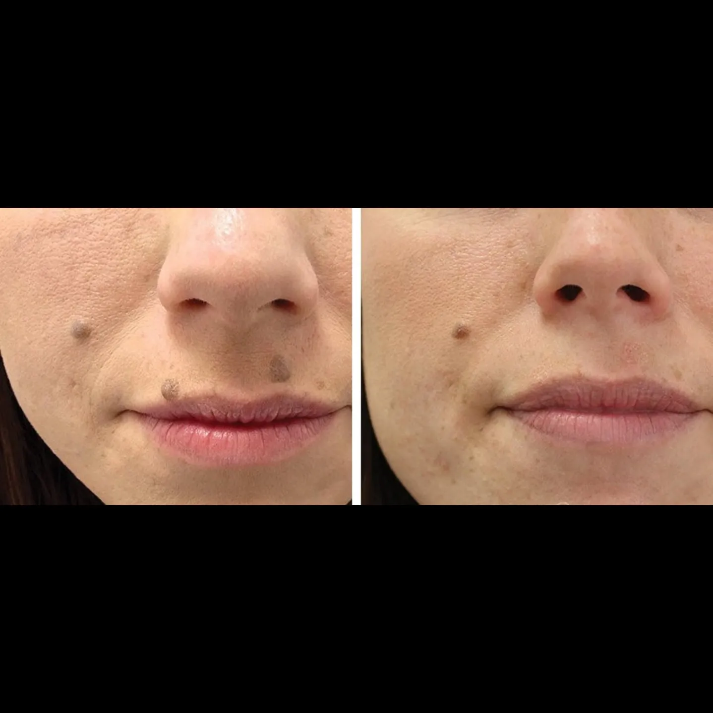 Mole excision at Rakesh Reddy's Skin Clinic in Sanjay Nagar, Hebbal, Bengaluru