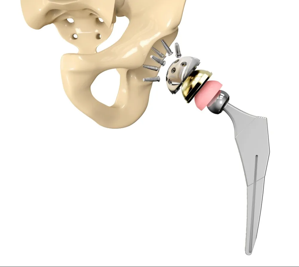 Hip Hemi-Arthroplasty for Elderly Patients in Castle Mill: When Is This Surgery Recommended?