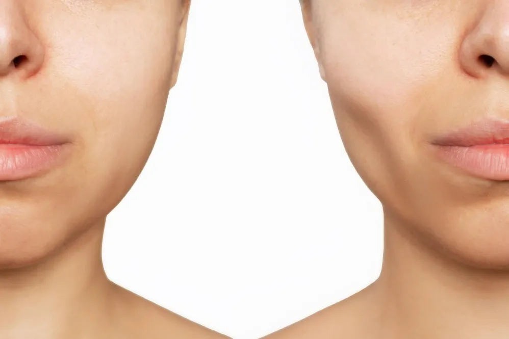Buccal Fat Removal for a More Defined Facial Appearance