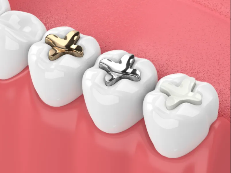 Restoration and Fillings: How to Treat Tooth Decay Before It Becomes a Bigger Problem