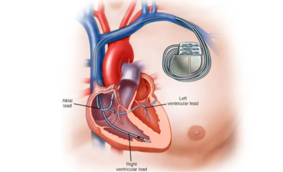 Cardiac Resynchronization Therapy Defibrillator (CRTD) in Kalyan: Advanced Care for Heart Failure Pa