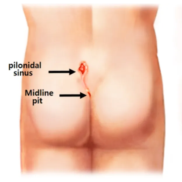 Pilonidal Sinus Surgery Compared With Conservative Care