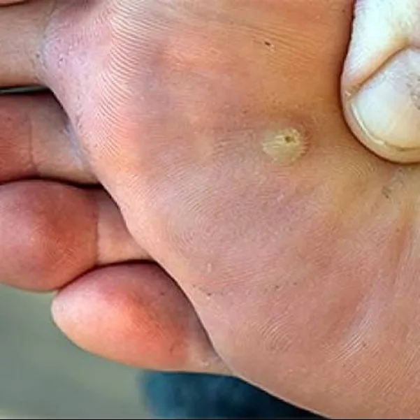 Plantar Corn excision at Rakesh Reddy's skin clinic, Sanjay Nagar, Hebbal, Bengaluru.