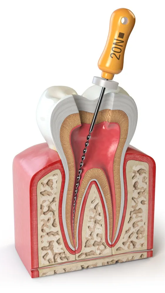Why Choosing a Painless Root Canal in Dwarka Can Save Your Natural Tooth