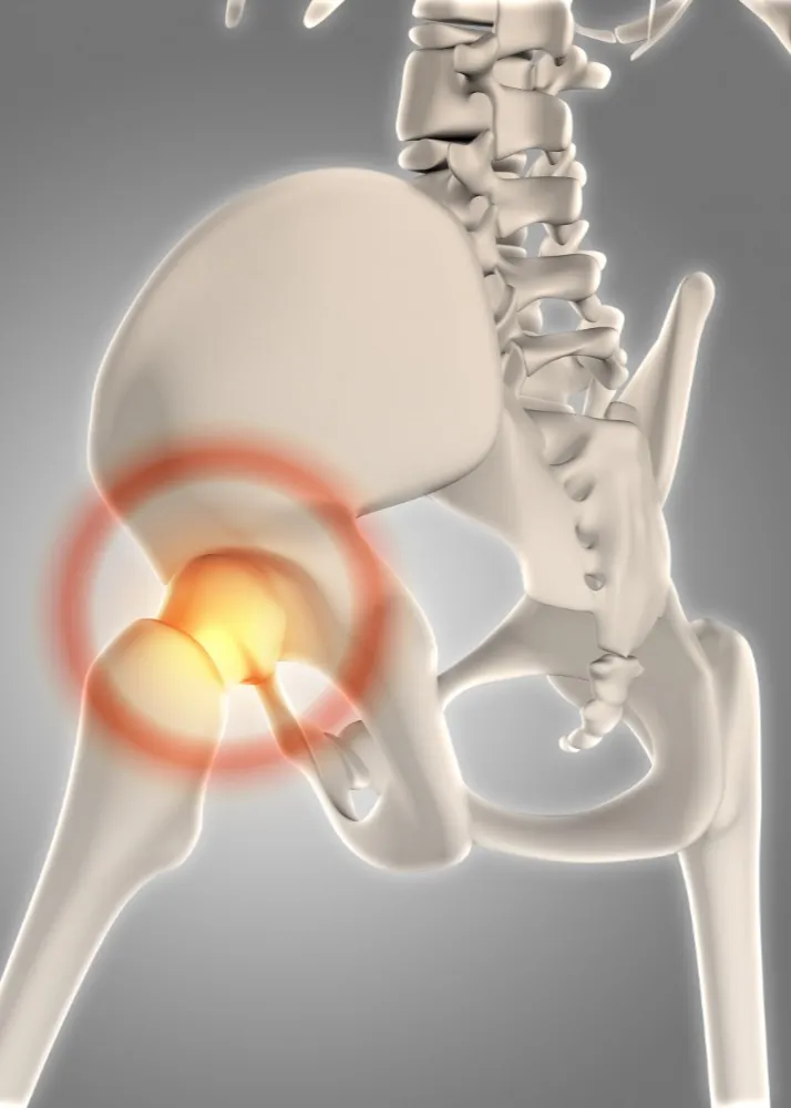 Total Hip Replacement Specialist in Moshi: Understanding When Hip Replacement Can Improve Mobility