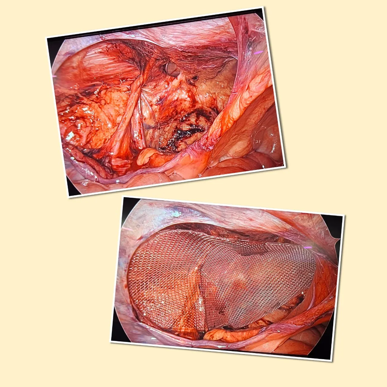 Laparoscopic inguinal Hernioplasty