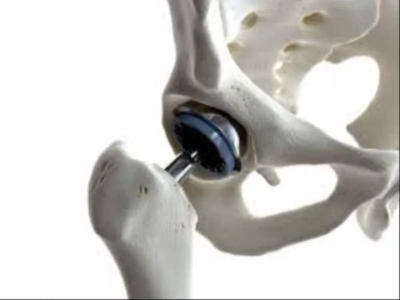 Joint Replacement in Chennai: Important Questions Patients Should Ask