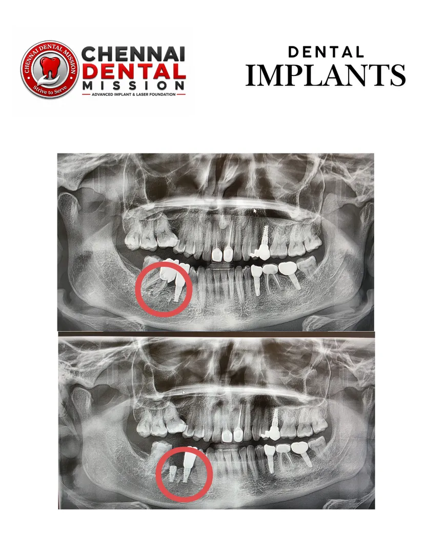 Is a Dental Implant the Best Way to Replace One Missing Tooth?