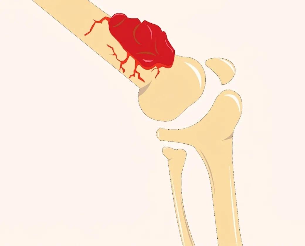 Can a Bone Tumor Be Benign or Cancerous? How Doctors Tell the Difference