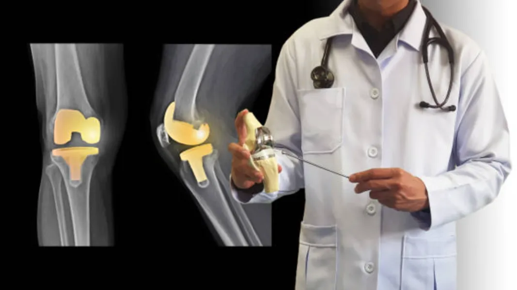 Total Knee Replacement in Santacruz, Khar and Bandra and What Patients Should Know Before Surgery