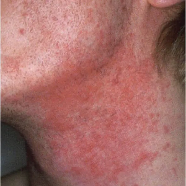 Treatment of skin allergies at Rakesh Reddy's Skin Clinic conveniently located at sanjay nagar, Hebb