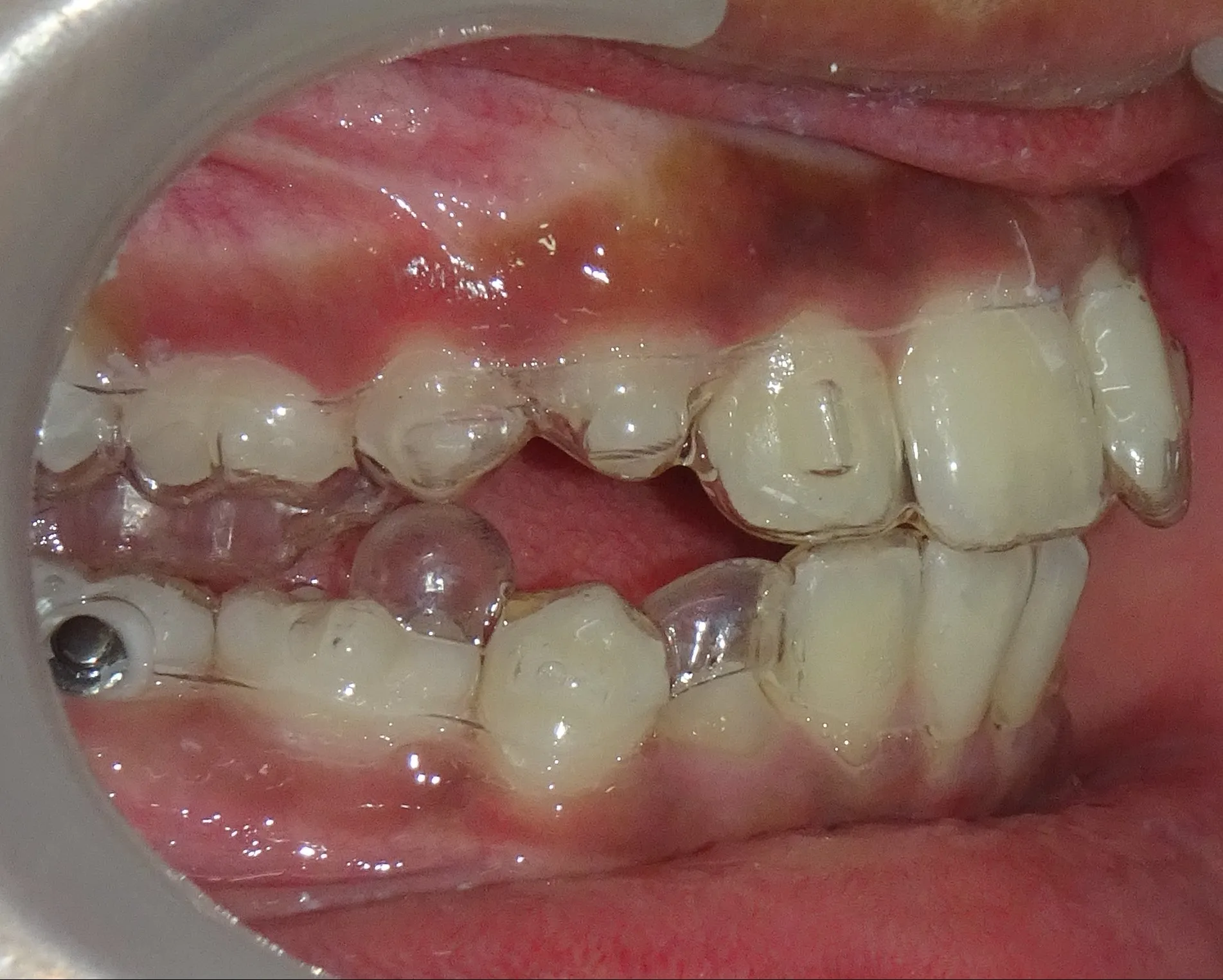 Correct the Bite. Align the Smile.... All at the Same Time