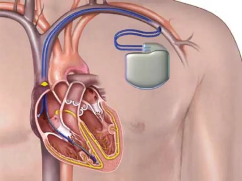 Automatic Implantable Cardioverter Defibrillator (AICD) in Kalyan: Protecting Patients from Sudden C
