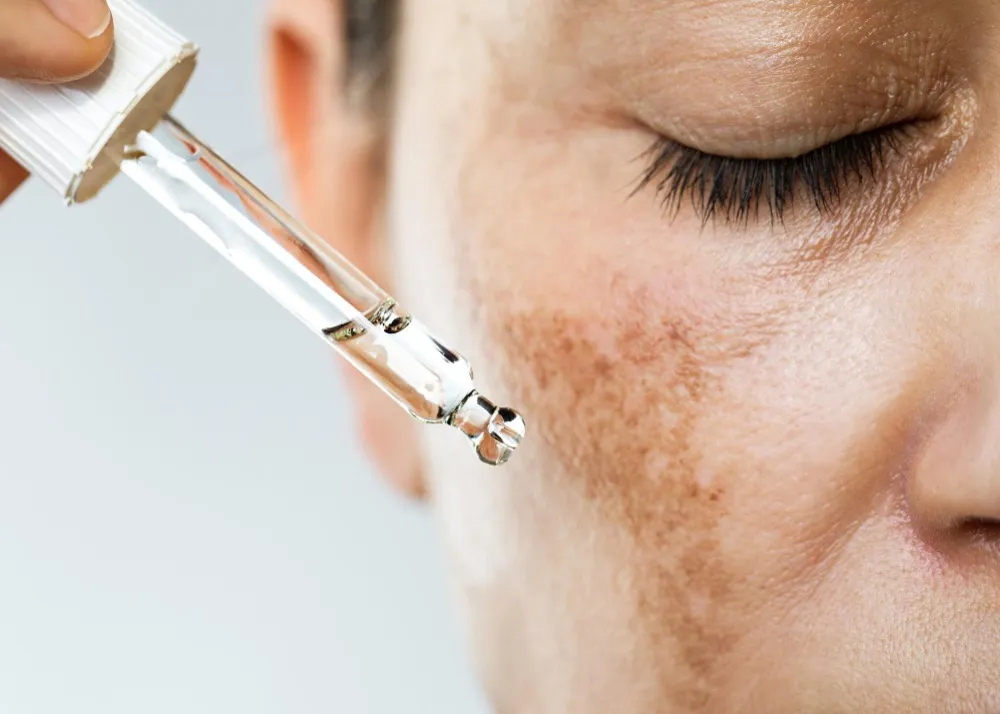 Melasma Treatment in Khandeshwar, Managing Stubborn Pigmentation with Expert Guidance