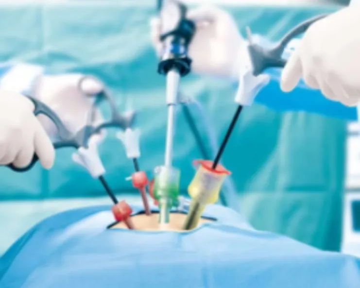 Laparoscopic Cholecystectomy Recovery Timeline Explained