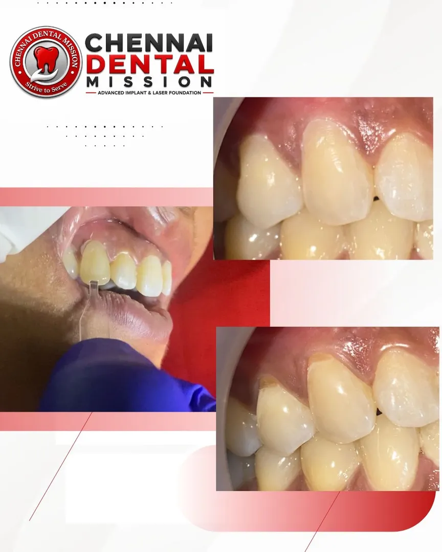 Digital Smile Design – See Your Smile Before Starting Treatment
One of the most exciting development...