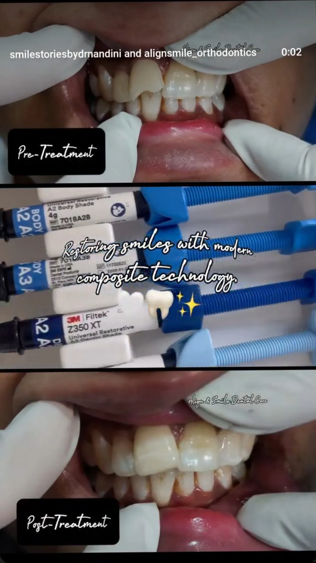 Composite Build-Up in Noida | Tooth-Coloured Restoration | Align & Smile Dental Care