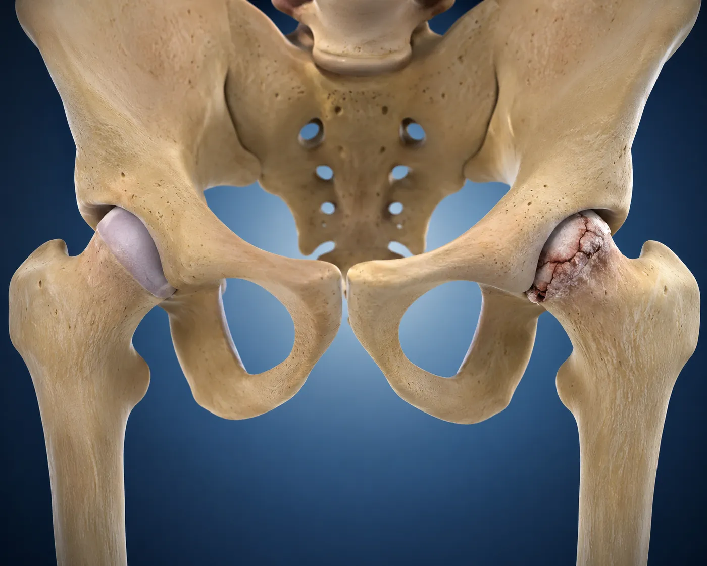 Avascular Necrosis of the Hip: Early Symptoms, Causes, and Treatment Options