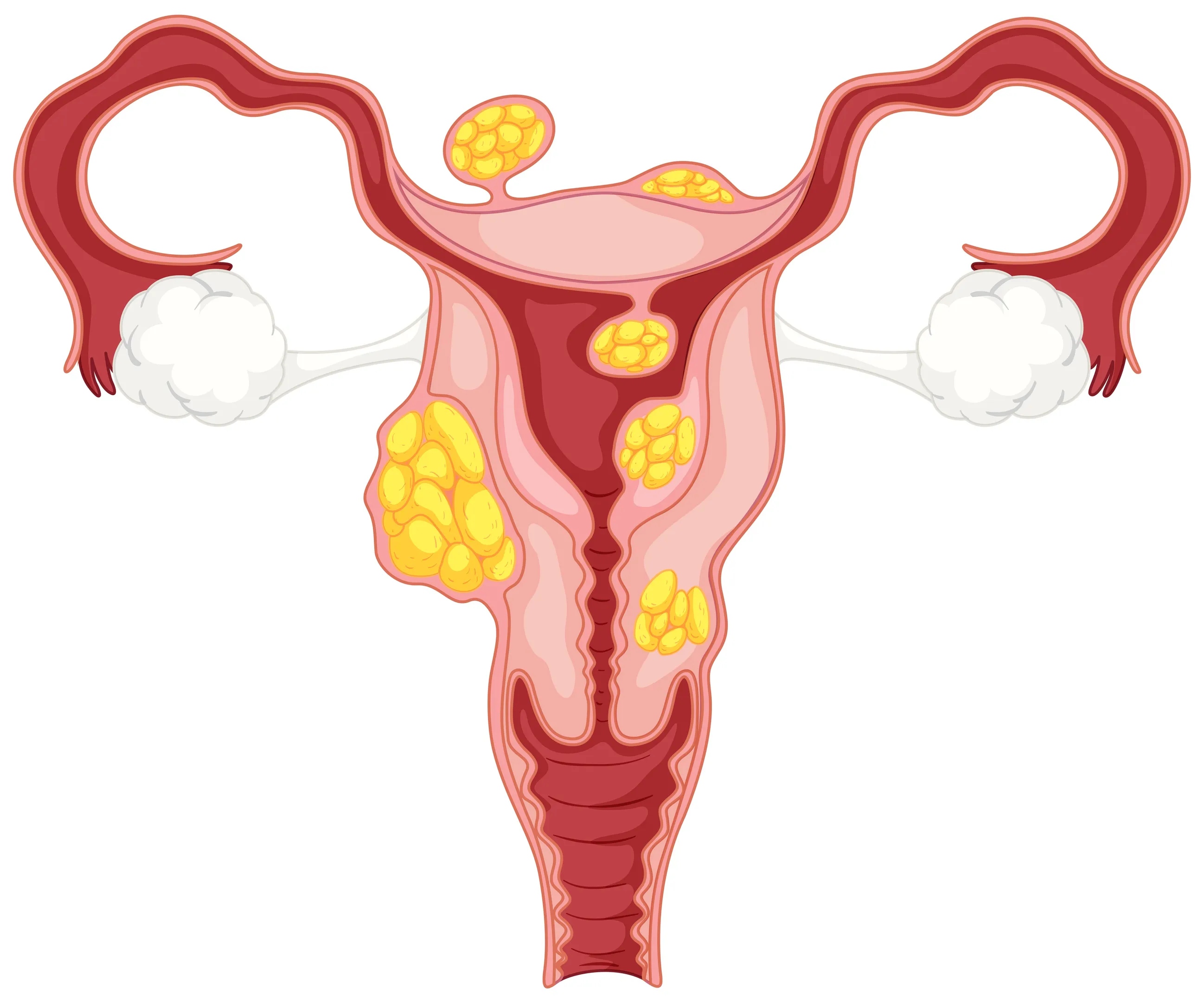 Fibroids Uterus Treatment in Byculla, When Should You Consider Medical Care?
