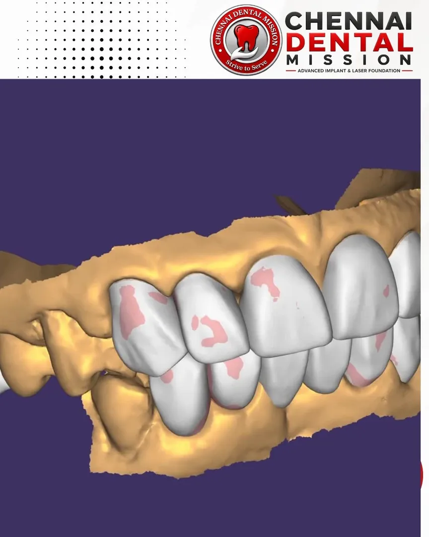 Can You See Your New Smile Before Starting Treatment? The Growing Demand for Digital Smile Design