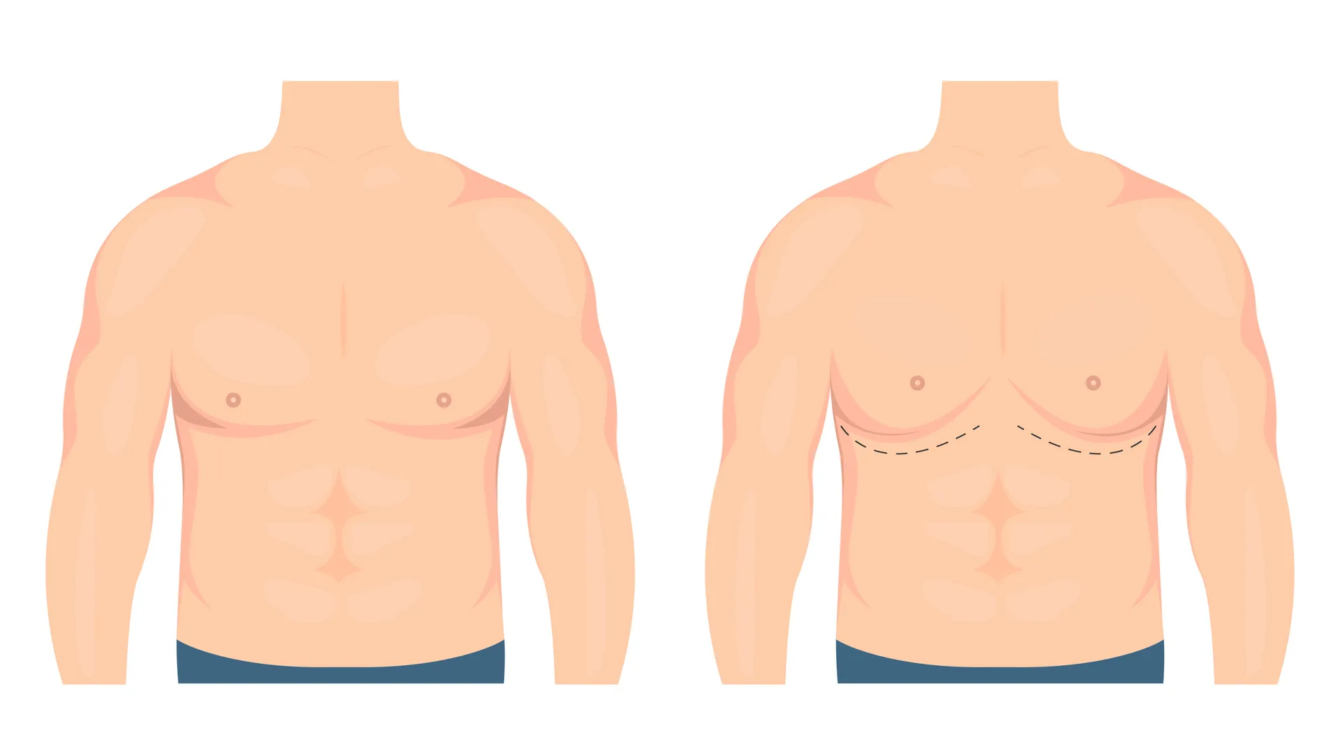 Gynecomastia Surgery Understanding Treatment Options for Enlarged Male Breasts