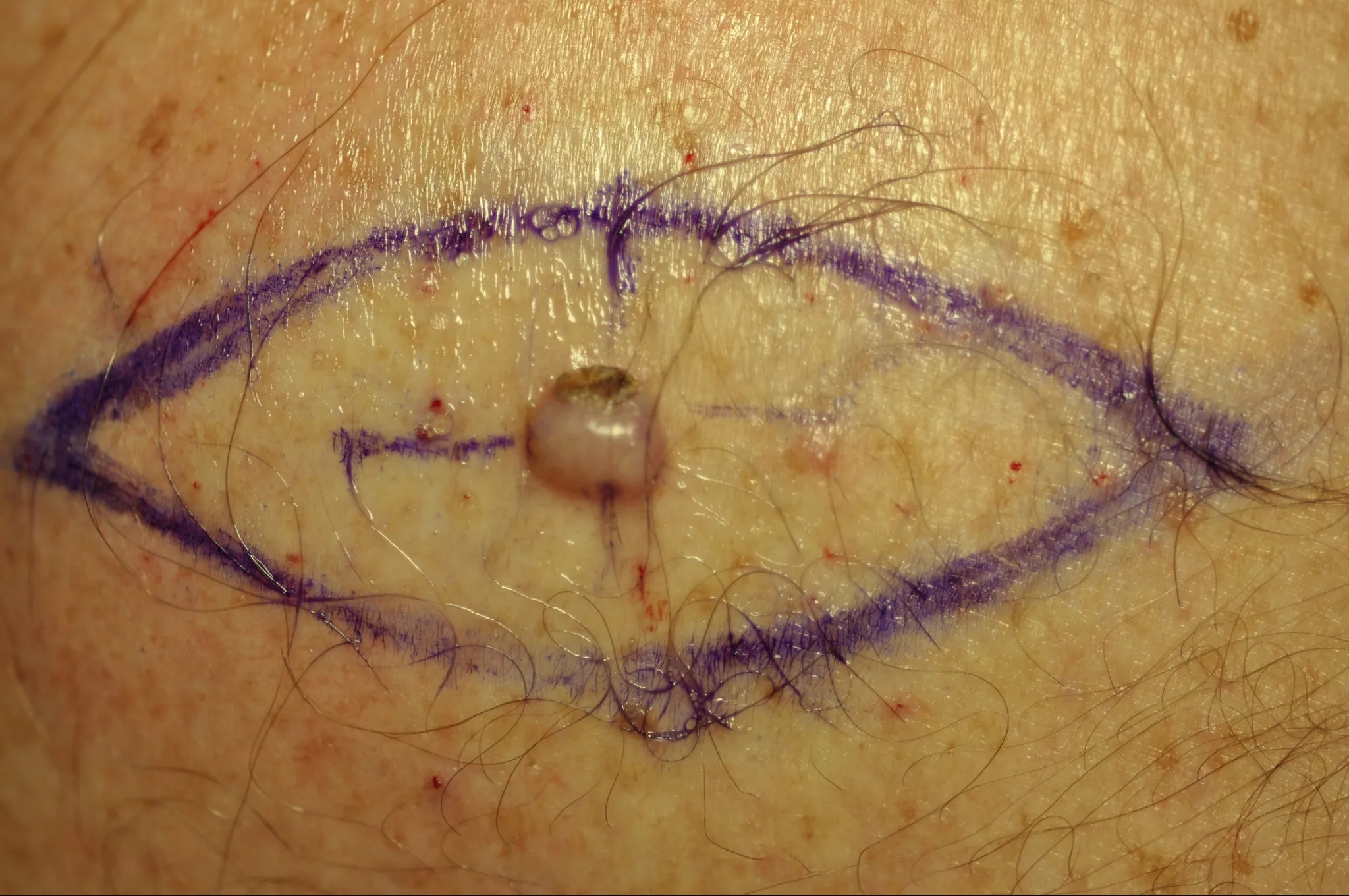 Removal of small benign tumors of the skin at Rakesh Reddy's Skin Clinic ,Sanjay nagar, Hebbal.