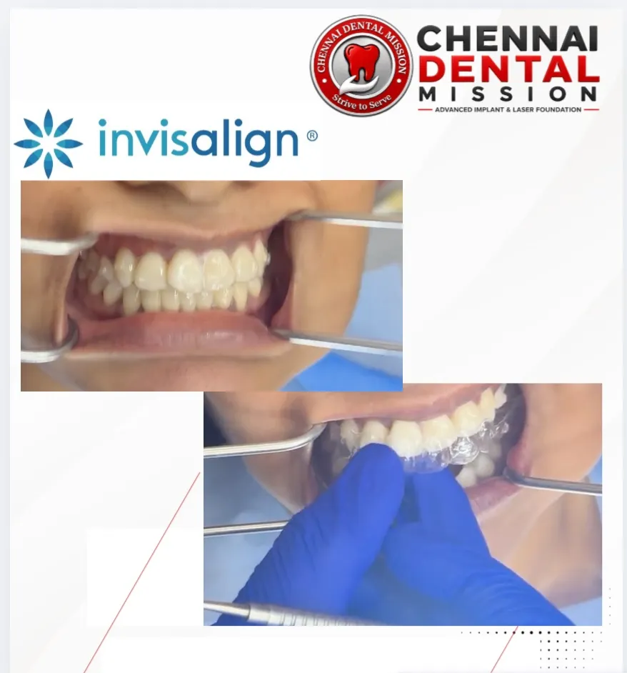 Thinking About Clear Aligners? 7 Questions Every Patient Should Ask Before Starting Treatment
