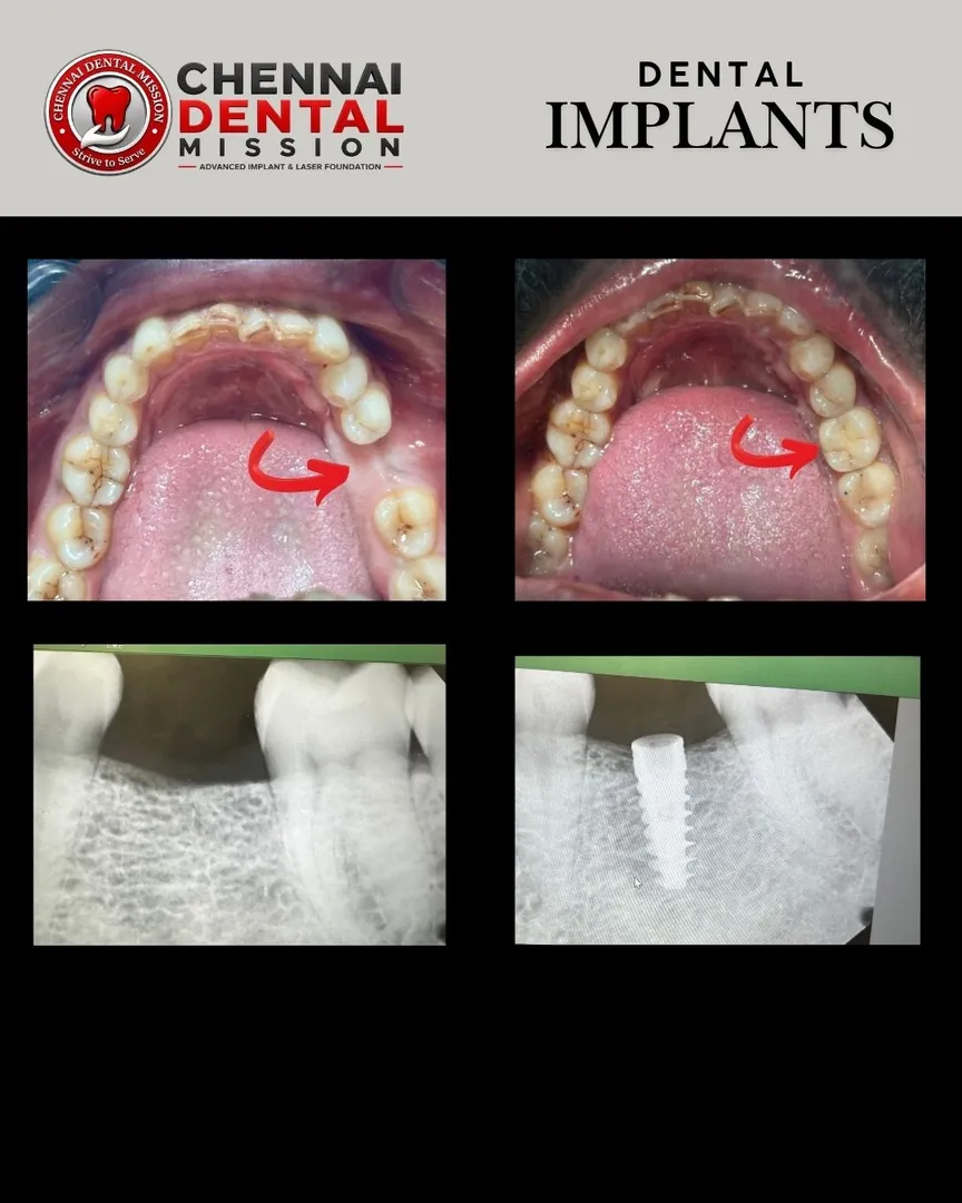 I Lost My Tooth Years Ago... Is It Too Late for a Dental Implant?