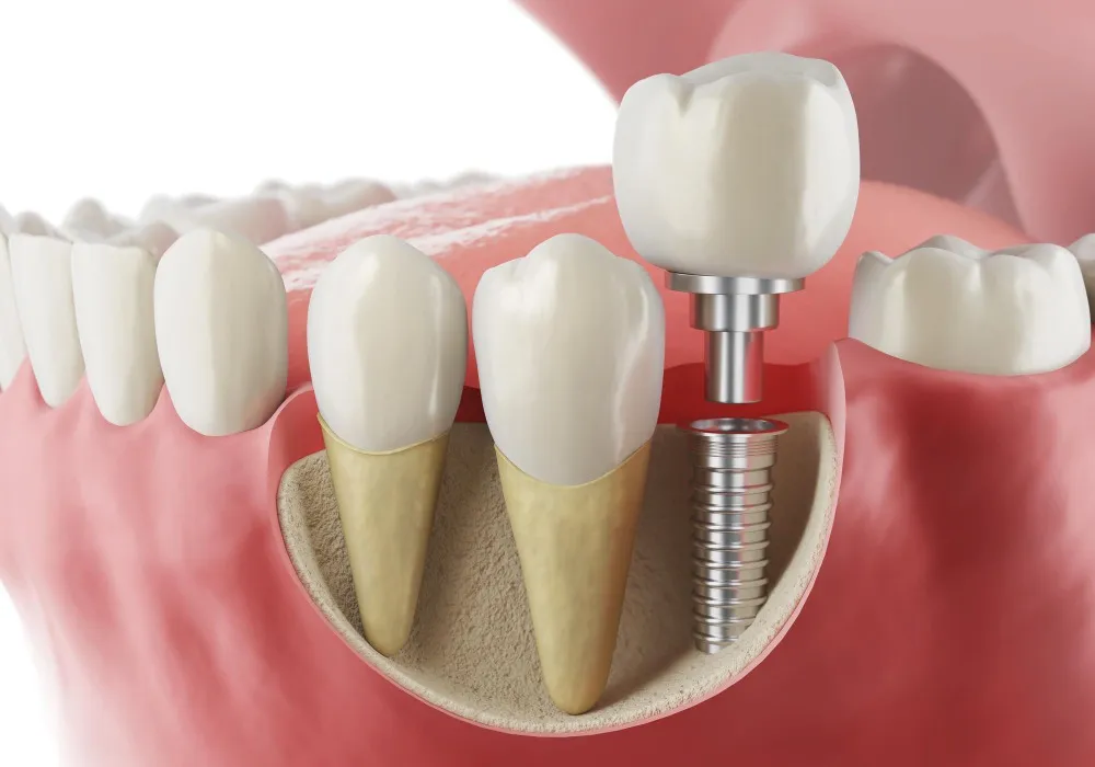 Implant Specialist vs General Dentist: Who Should You Consult for Missing Teeth?