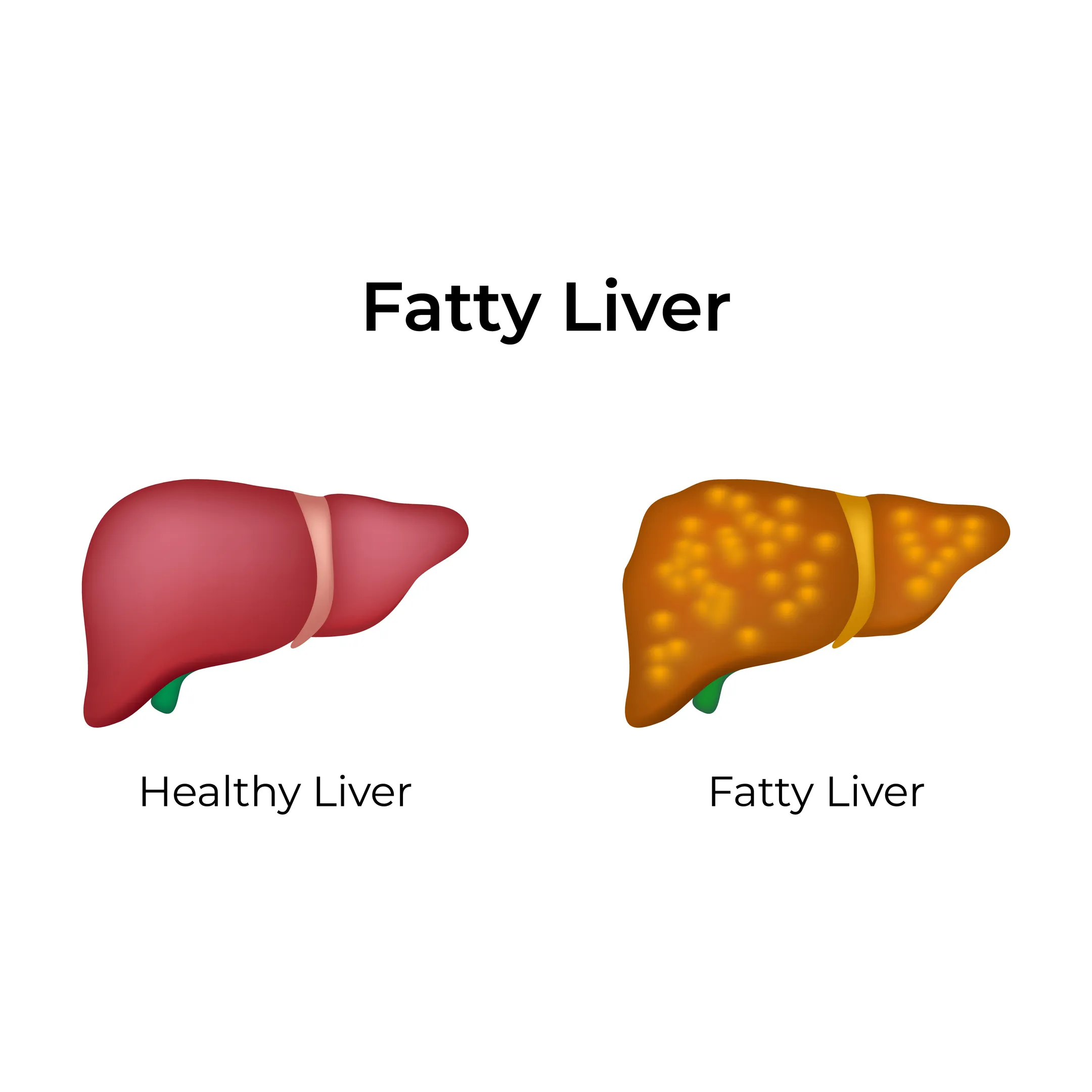 Understanding Fatty Liver Disease Before It Becomes a Serious Health Concern