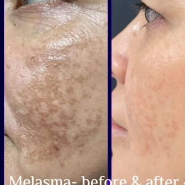 PICO LASER for pigmentation at Rakesh Reddy's Skin Clinic in Sanjay Nagar, Hebbal, Bengaluru
