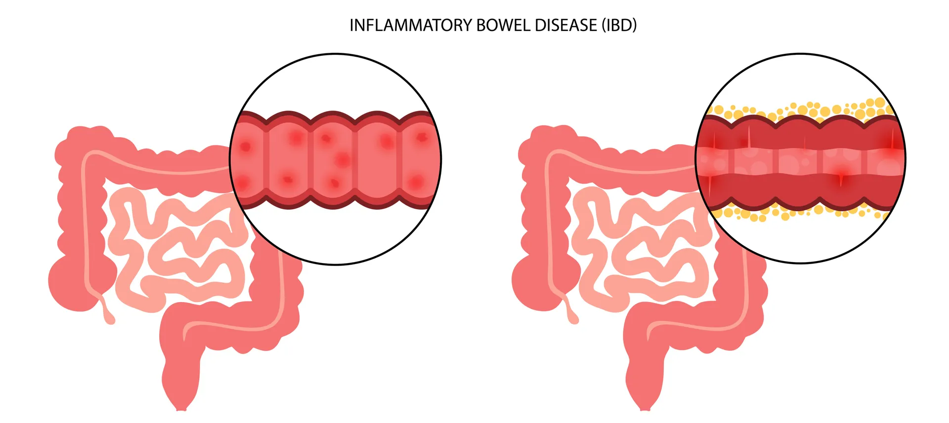Signs You May Need Advanced Biologic Therapy for Inflammatory Bowel Disease