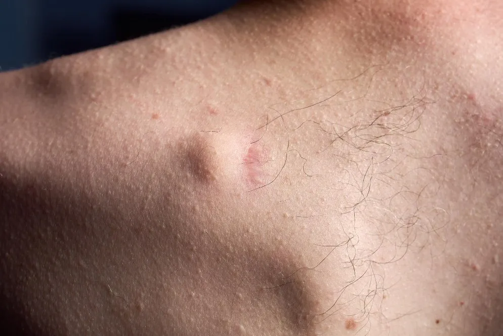 What You Should Know About Lipoma Surgery in Dadar