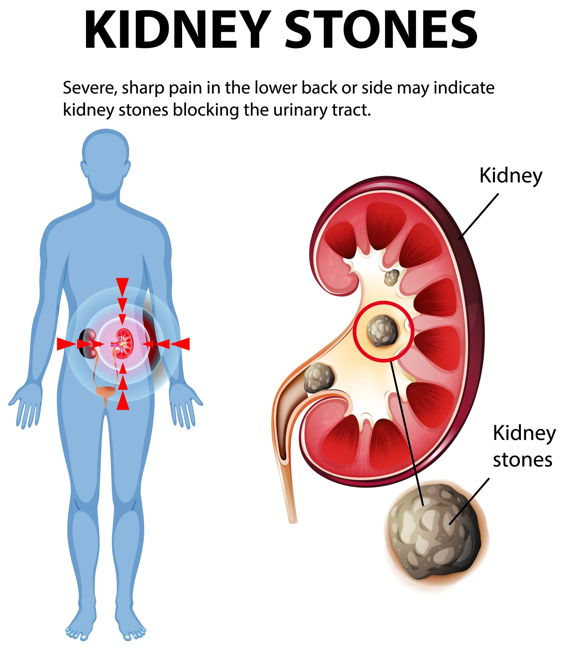 Kidney Stone Surgery in Pratap Nagar: When Is a Procedure Actually Needed?