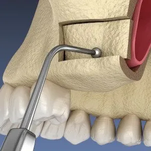 Best Sinus Lift Surgery in NIBM Road