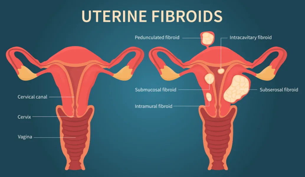 Recognizing Fibroids Before They Affect Your Daily Life