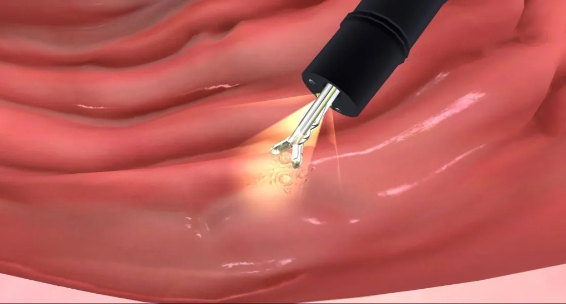 Laser Treatment for Fissure and Fistula in Chembur: Understanding the Difference and Choosing