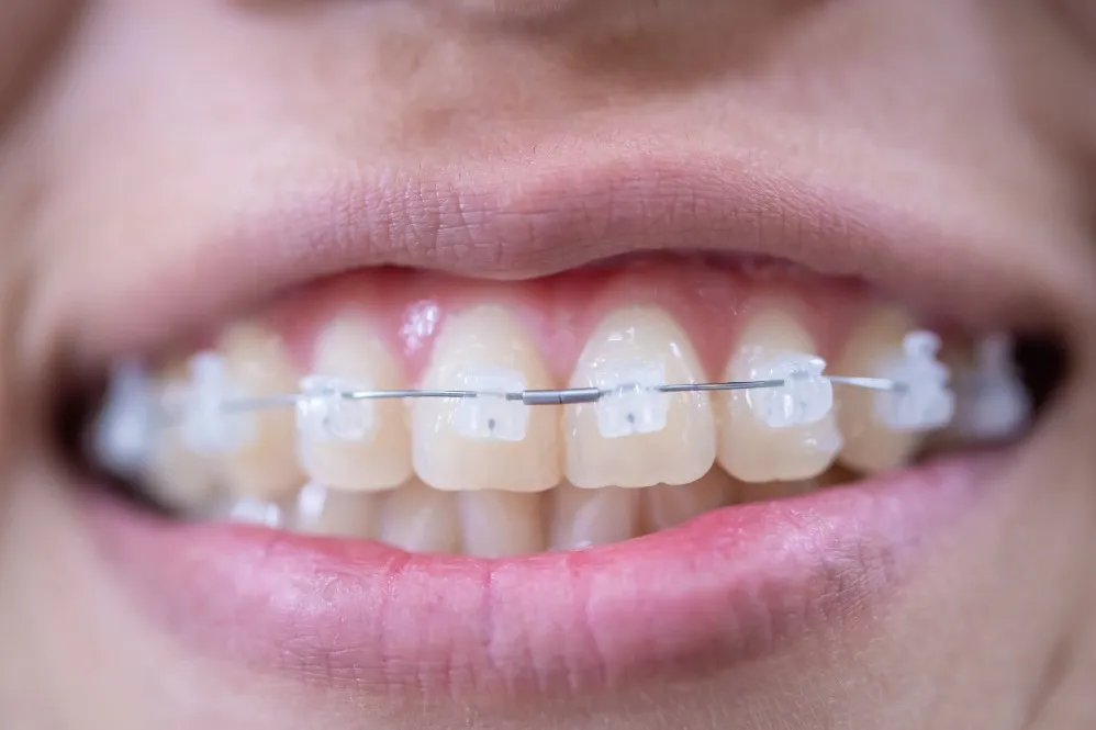 How to Choose Ceramic Braces for Effective and Discreet Teeth Alignment