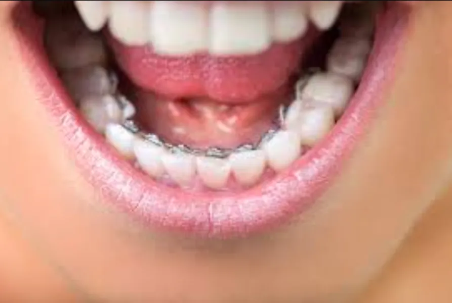 Lingual Braces Treatment: An Invisible Orthodontic Option for Adults