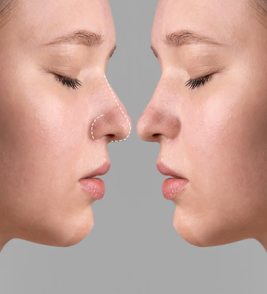 Choosing Rhinoplasty Surgery: What to Check Before Making a Decision