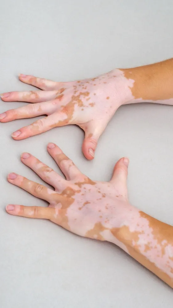 Building Confidence Through Vitiligo Repigmentation Therapy With Personalized Care