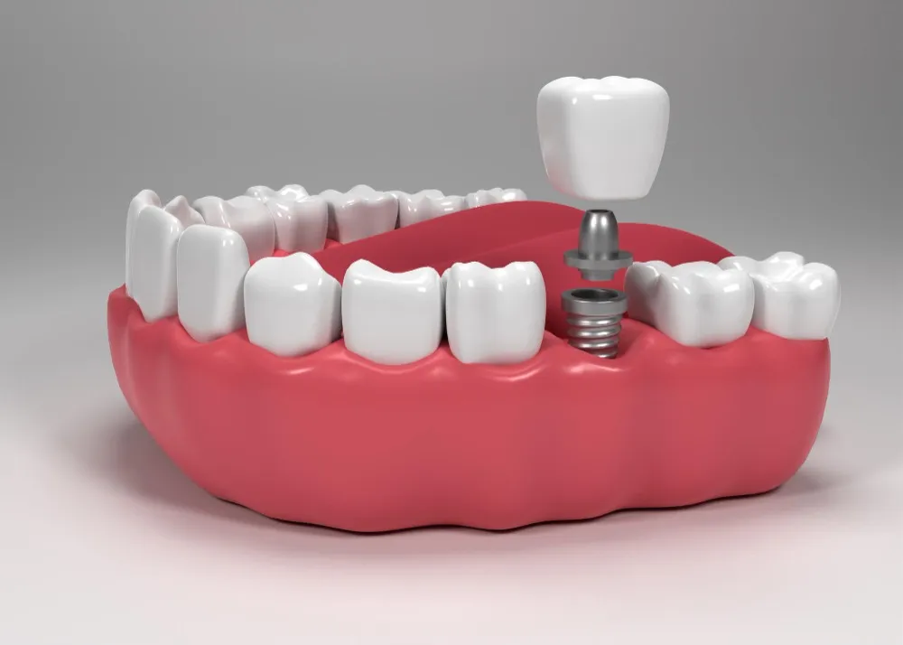 Choosing Dental Implants That Support Long Term Tooth Replacement