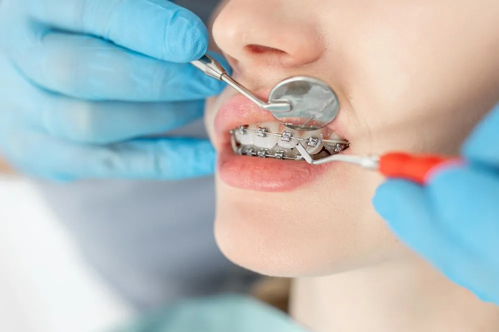 Braces Treatment in Borivali: A Checklist for Selecting the Right Orthodontic Plan