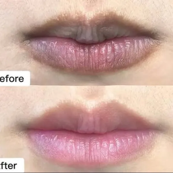 PICO LASER for lip pigmentation at Rakesh Reddy's skin clinic conveniently located at Sanjay Nagar,