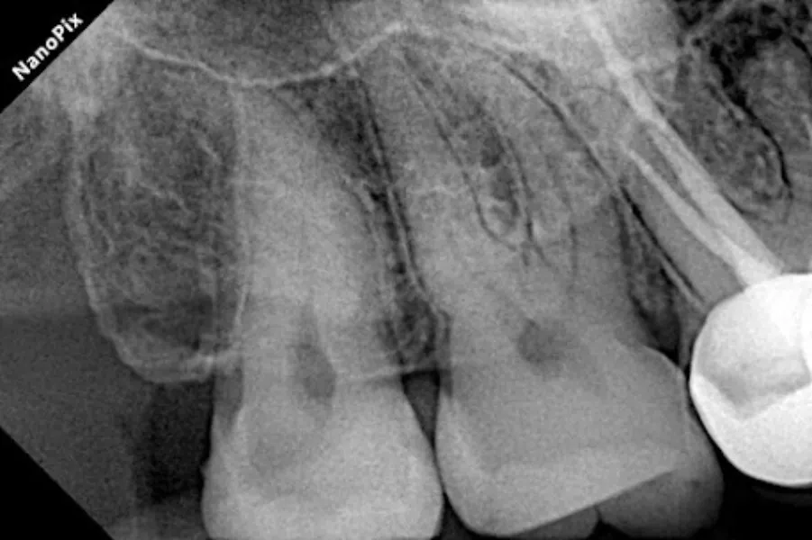 🦷 Painless Wisdom Tooth Extraction in Manpada, Thane West 🦷Are you suffering from severe jaw or ba...