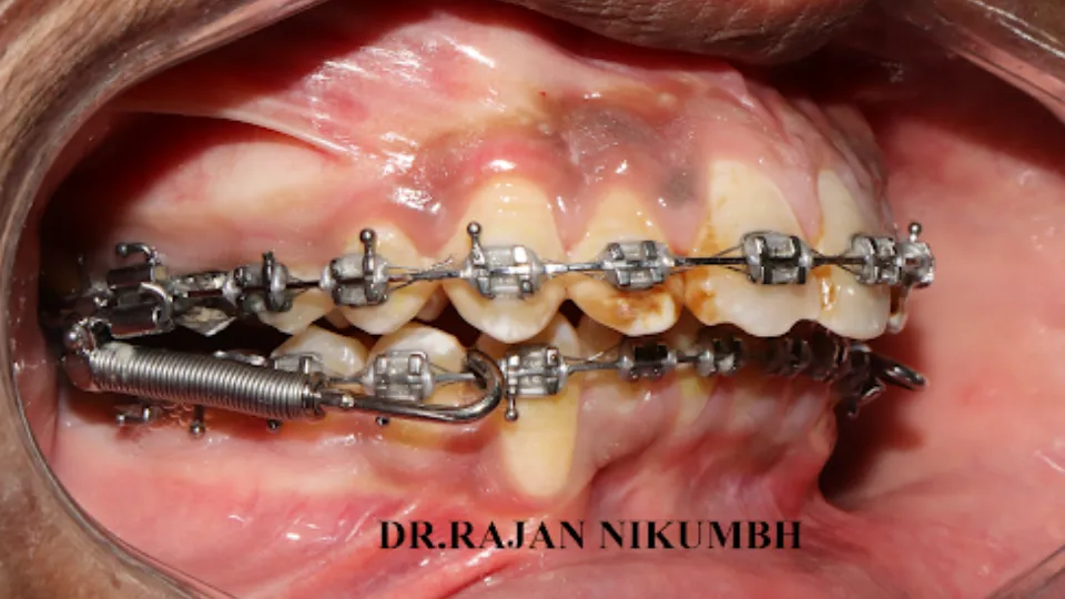 Braces treatment is a highly specialized orthodontic procedure that uses gentle, continuous pressure...